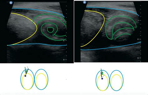 whirlpool sign testicular torsion ultrasound